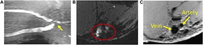 Medical Image-Based Computational Fluid Dynamics and Fluid-Structure Interaction Analysis in Vascular Diseases